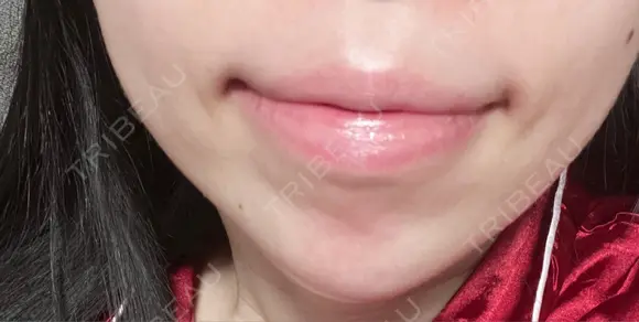 ヒアルロン酸注入（あご） TCB東京中央美容外科 堺院 AFTER メイン用