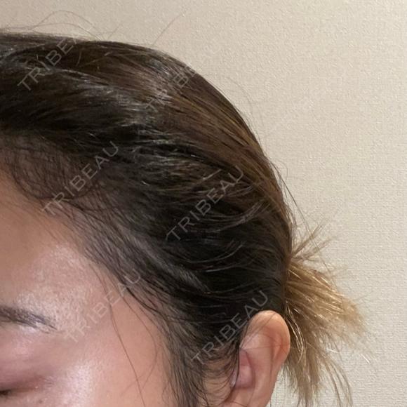 アートメイク（ヘアライン） トイトイトイクリニック 池袋院 AFTER メイン用
