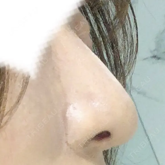 鼻尖形成（切開） / 鼻中隔延長（切開） / 小鼻縮小（切開） / 軟骨移植 / 骨切幅寄せ リラ・クラニオフェイシャル・クリニック DAY 555 メイン用