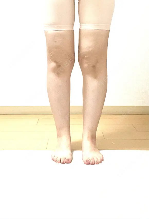 脂肪吸引（脚） THE CLINIC（ザ・クリニック） 名古屋院 AFTER メイン用