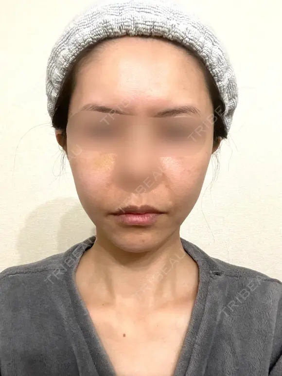 脂肪吸引（顔） / 切開リフト / 脂肪注入（輪郭） 牧野美容クリニック AFTER メイン用