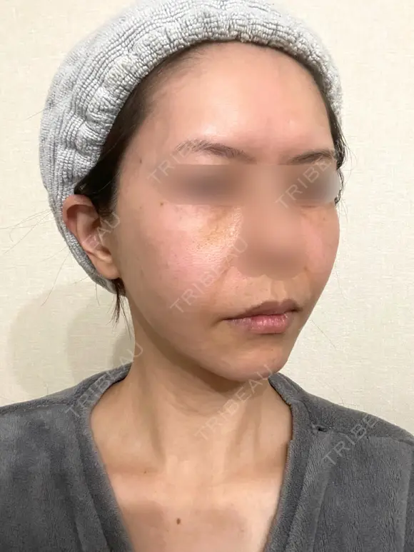 脂肪吸引（顔） / 切開リフト / 脂肪注入（輪郭） 牧野美容クリニック DAY 654 メイン用