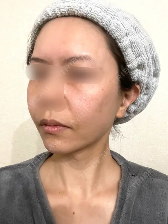 脂肪吸引（顔） / 切開リフト / 脂肪注入（輪郭） 牧野美容クリニック DAY 654 メイン用