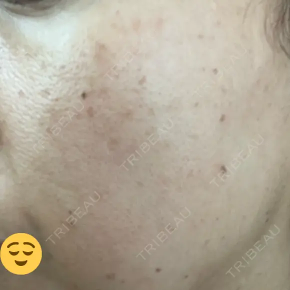 美肌レーザー / シミ取りレーザー あいちビューティークリニック DAY 1 メイン用