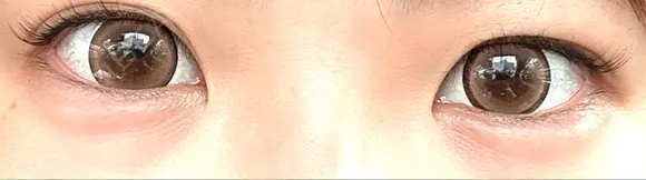 ヒアルロン酸注入（涙袋） TCB東京中央美容外科 長野院 DAY 0 メイン用