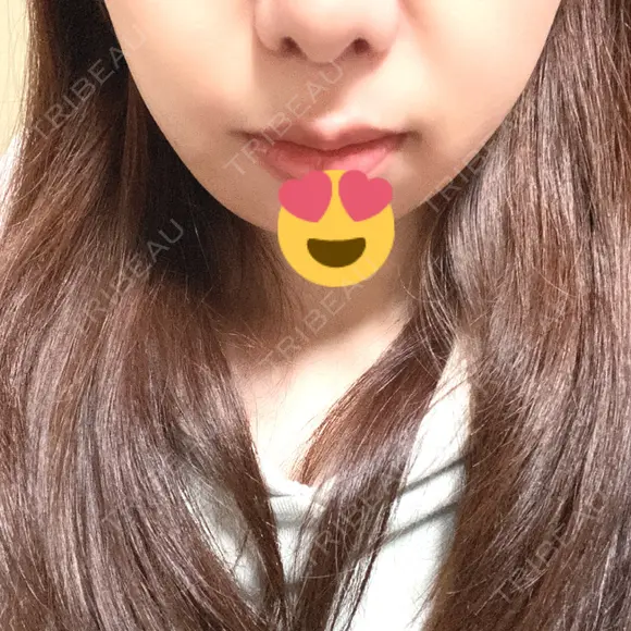 人中短縮 心斎橋中央クリニック DAY 12 メイン用