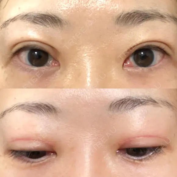 二重切開 / 上まぶたたるみ取り / PRP皮膚再生療法 BRIGHTS beauty clinic DAY 62 メイン用
