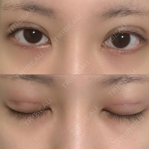 二重埋没 NARU Beauty Clinic 【ナルクリ】 DAY 1 メイン用