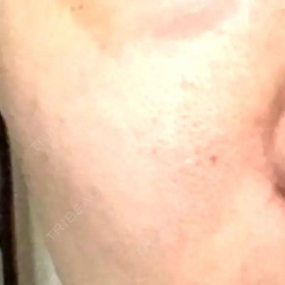 毛穴洗浄（ハイドラフェイシャルなど） 東京素肌クリニック 銀座本院 DAY 31 メイン用