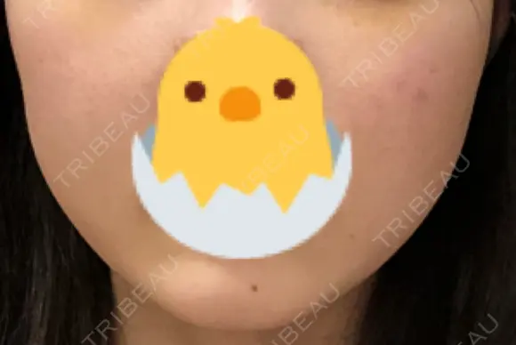 ボトックス（エラ・小顔） TCB東京中央美容外科 長野院 DAY 7 メイン用