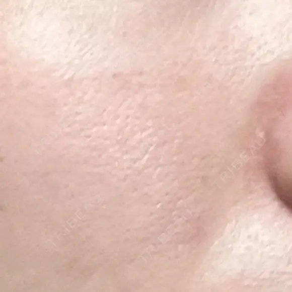 毛穴洗浄（ハイドラフェイシャルなど） 東京素肌クリニック 銀座本院 DAY 32 メイン用