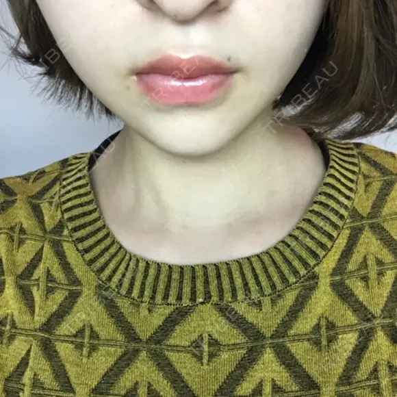 あごプロテーゼ 恵聖会クリニック 京橋院 DAY 20 メイン用