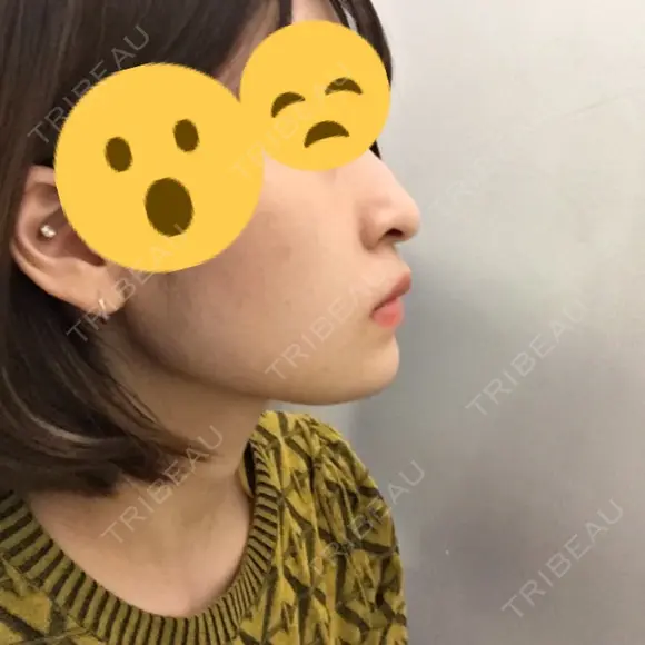 あごプロテーゼ 恵聖会クリニック 京橋院 DAY 20 メイン用