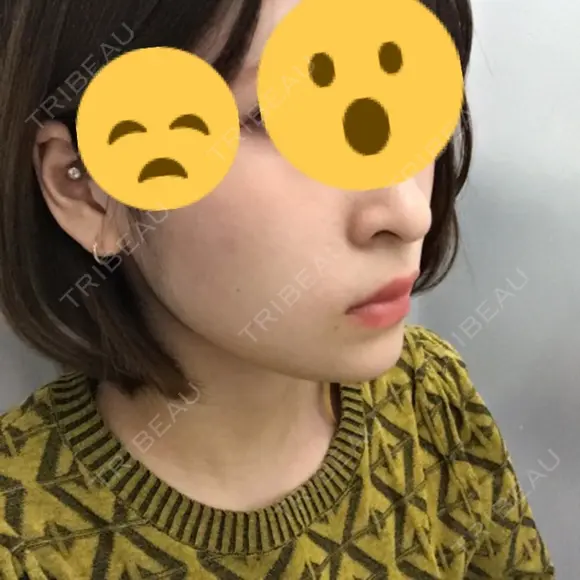あごプロテーゼ 恵聖会クリニック 京橋院 DAY 20 メイン用