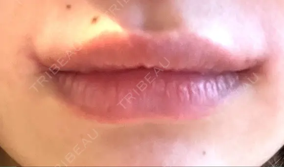 口角挙上 くさのたろうクリニック DAY 20 メイン用