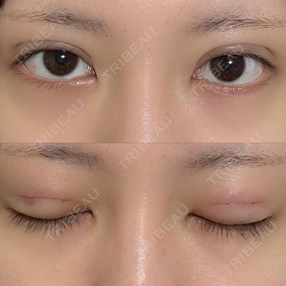 二重埋没 NARU Beauty Clinic 【ナルクリ】 DAY 2 メイン用