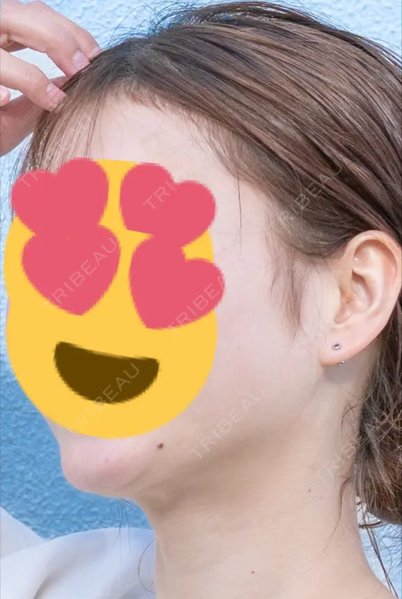 糸リフト / 脂肪吸引（顔） 湘南美容クリニック 大阪心斎橋院 DAY 520 メイン用