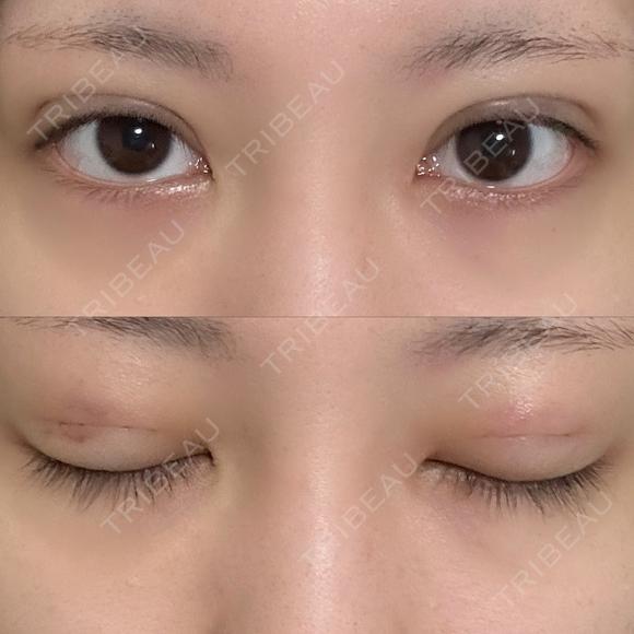 二重埋没 NARU Beauty Clinic 【ナルクリ】 DAY 3 メイン用