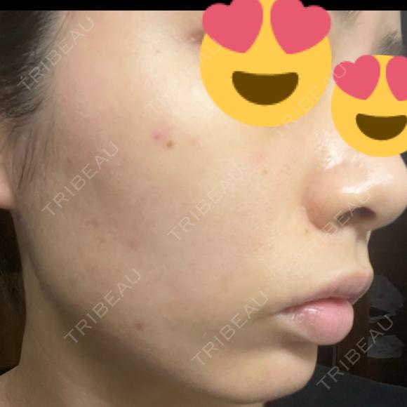 ヴェルヴェットスキン ジョウクリニック 松山院 DAY 4 メイン用