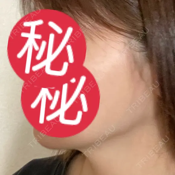 その他（輪郭） / 医療痩身（顔） WOM CLINIC GINZA （ワム クリニック ギンザ） DAY 172 メイン用