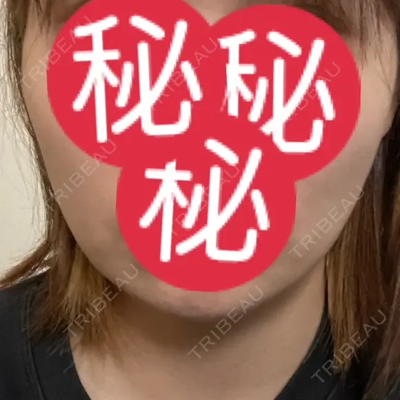 その他（輪郭） / 医療痩身（顔） WOM CLINIC GINZA （ワム クリニック ギンザ） DAY 174 メイン用