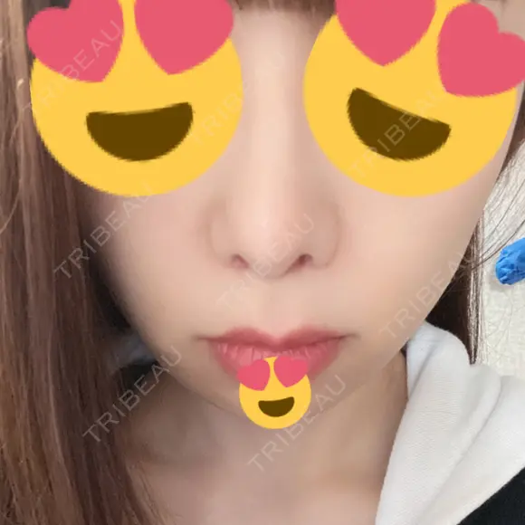 人中短縮 心斎橋中央クリニック DAY 14 メイン用