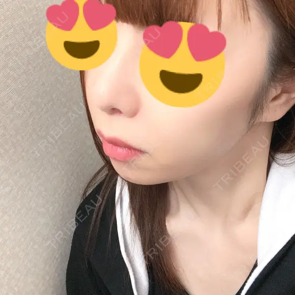 人中短縮 心斎橋中央クリニック DAY 14 メイン用