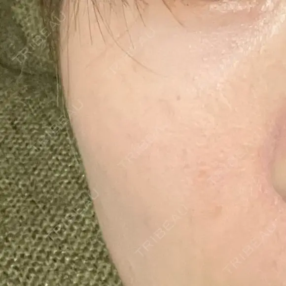 毛穴洗浄（ハイドラフェイシャルなど） 東京素肌クリニック 銀座本院 DAY 89 メイン用