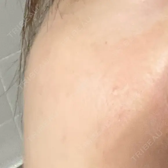 毛穴洗浄（ハイドラフェイシャルなど） 東京素肌クリニック 銀座本院 DAY 119 メイン用