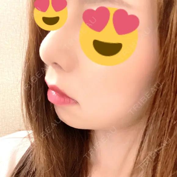 人中短縮 心斎橋中央クリニック DAY 15 メイン用