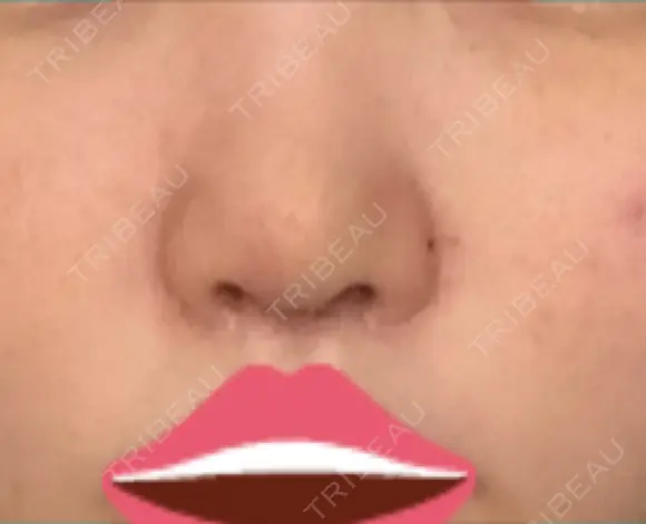 鼻尖形成（切開） / 軟骨移植 JUN CLINIC DAY 6 メイン用