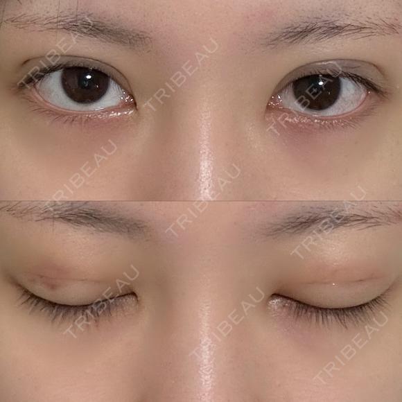 二重埋没 NARU Beauty Clinic 【ナルクリ】 DAY 4 メイン用