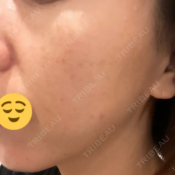 美肌レーザー / シミ取りレーザー あいちビューティークリニック DAY 8 メイン用