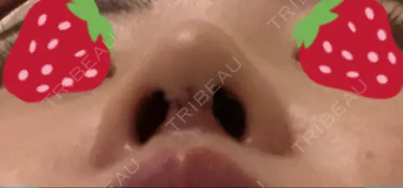 鼻尖形成（切開） / 軟骨移植 JUN CLINIC DAY 7 メイン用