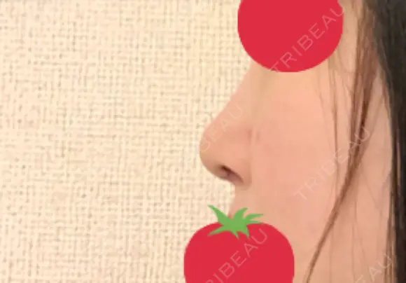 鼻尖形成（切開） / 軟骨移植 JUN CLINIC DAY 7 メイン用