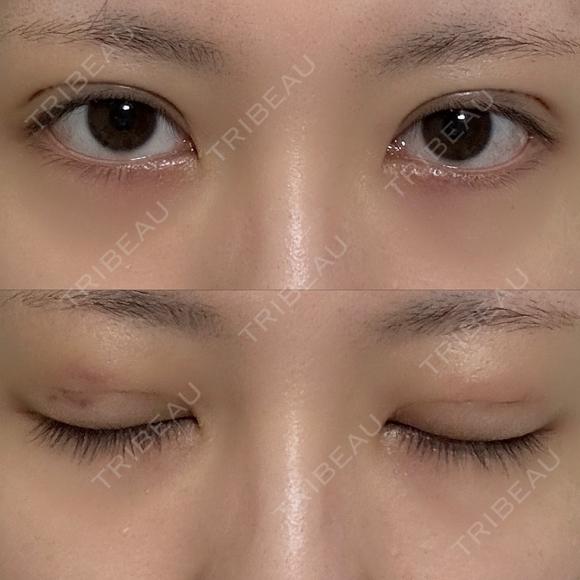二重埋没 NARU Beauty Clinic 【ナルクリ】 DAY 5 メイン用