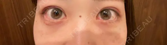 二重埋没 / クマ治療 / 上まぶたの脂肪取り リッツ美容外科 東京院 DAY 22 メイン用