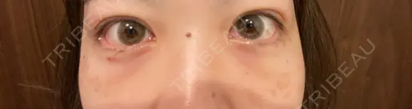 二重埋没 / クマ治療 / 上まぶたの脂肪取り リッツ美容外科 東京院 DAY 25 メイン用