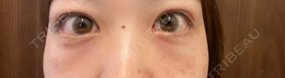 二重埋没 / クマ治療 / 上まぶたの脂肪取り リッツ美容外科 東京院 AFTER メイン用