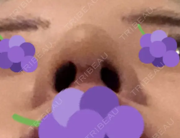 鼻尖形成（切開） / 軟骨移植 JUN CLINIC DAY 8 メイン用