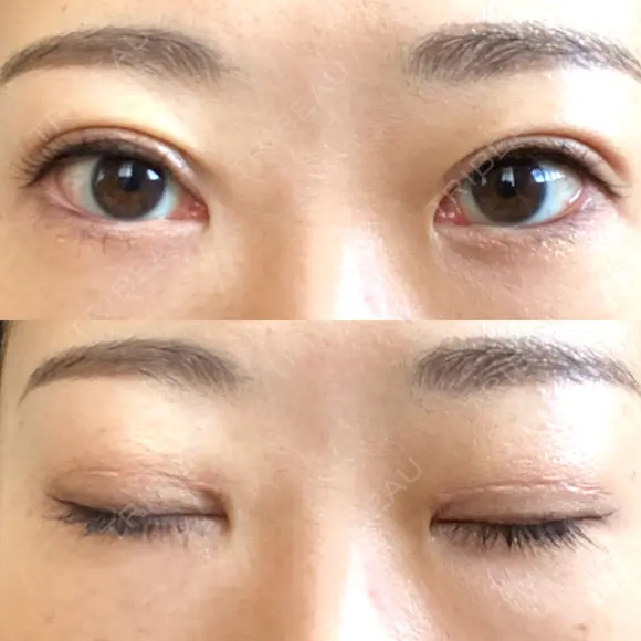 二重切開 / 上まぶたたるみ取り / PRP皮膚再生療法 BRIGHTS beauty clinic DAY 70 メイン用