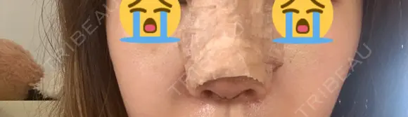 鼻中隔延長（切開） / 鼻尖縮小 ビスポーククリニック 福岡院 DAY 3 メイン用