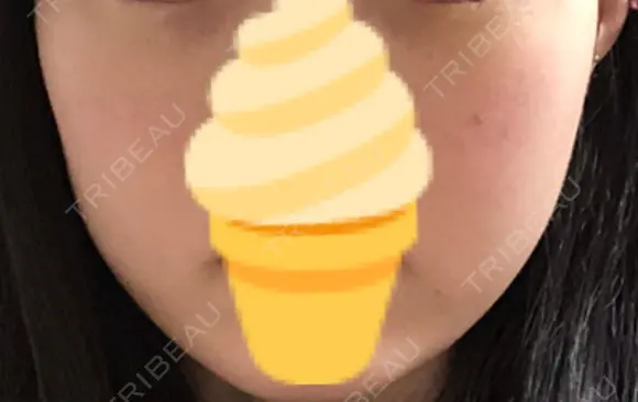 ボトックス（エラ・小顔） TCB東京中央美容外科 長野院 DAY 13 メイン用