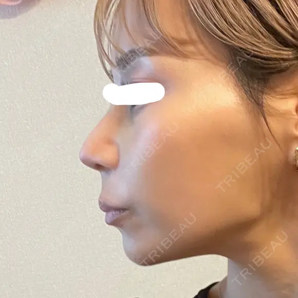 鼻尖形成（切開） / 鼻中隔延長（切開） / 軟骨移植 / 鼻翼基部形成（貴族手術） / 鼻柱下降・鼻唇角形成（猫手術） MAe Clinic 東京院 DAY 13 メイン用