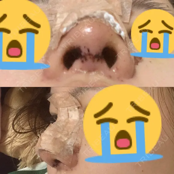 鼻中隔延長（切開） / 鼻尖縮小 ビスポーククリニック 福岡院 DAY 3 メイン用