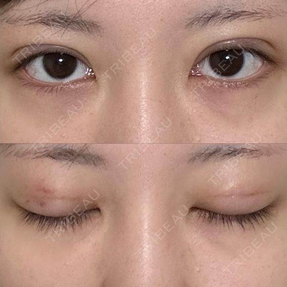 二重埋没 NARU Beauty Clinic 【ナルクリ】 DAY 8 メイン用
