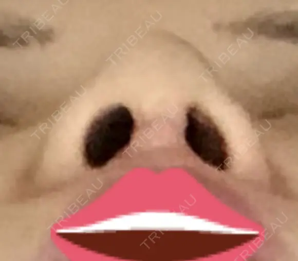 鼻尖形成（切開） / 軟骨移植 JUN CLINIC DAY 10 メイン用