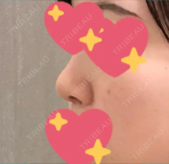 鼻尖形成（切開） / 軟骨移植 JUN CLINIC DAY 11 メイン用