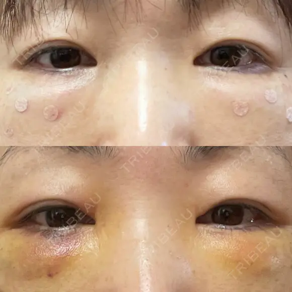 クマ治療 / 脂肪注入（肌） / ボトックス（あご） 銀座みゆき通り美容外科 大阪梅田院 DAY 3 メイン用