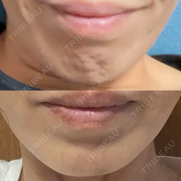 クマ治療 / 脂肪注入（肌） / ボトックス（あご） 銀座みゆき通り美容外科 大阪梅田院 DAY 3 メイン用